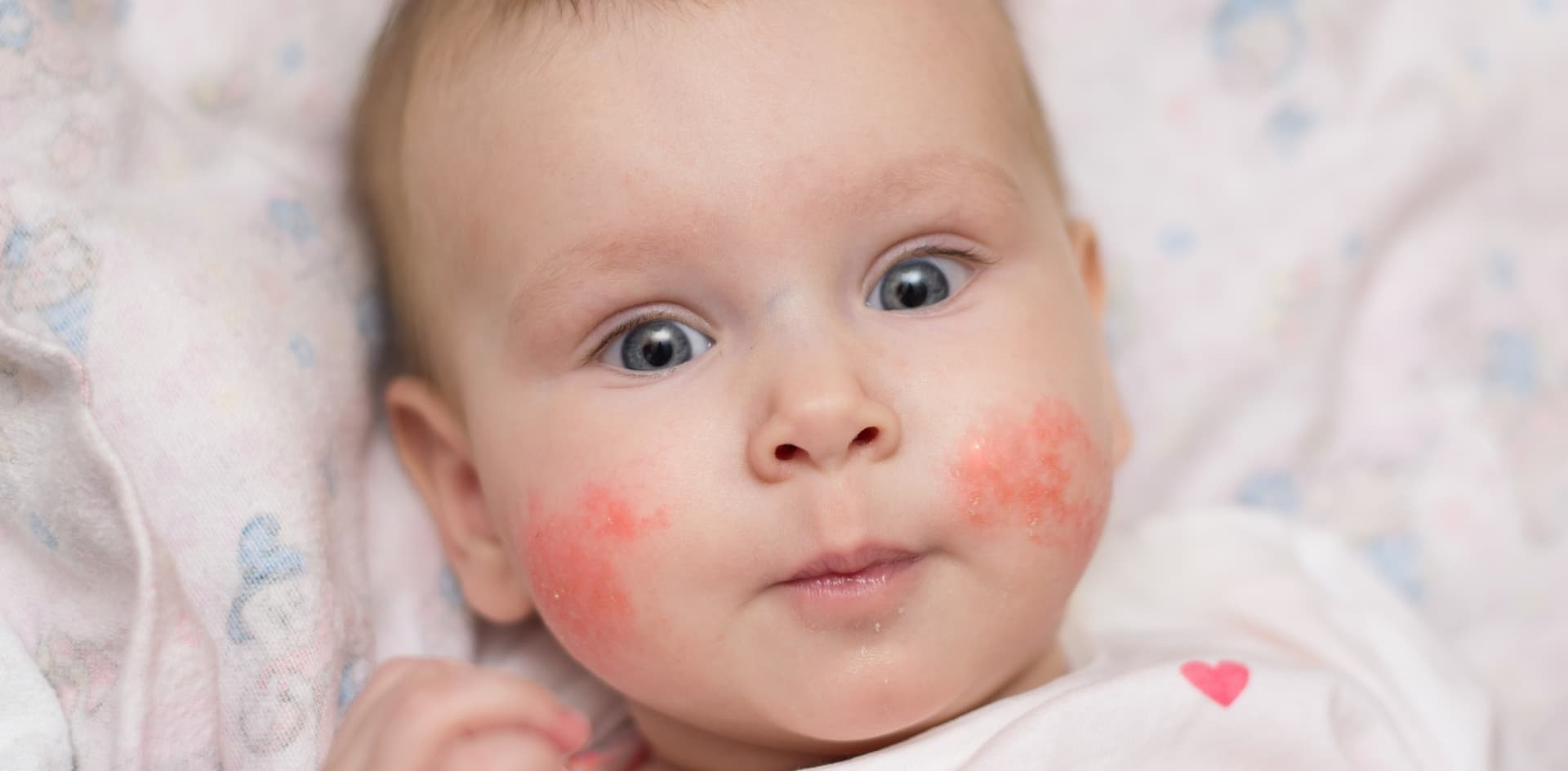 Neurodermitis bei Babys: Symptome und Behandlung